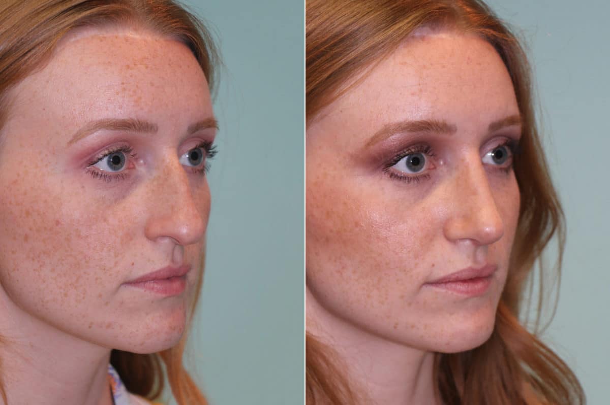 Before and after Rhinoplasty by Dr. Shervin Naderi, Patient 19638