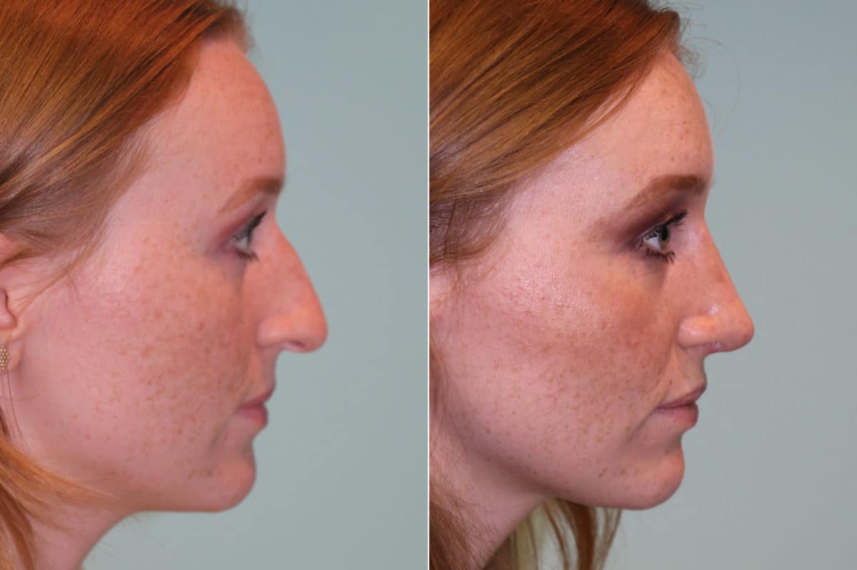 Before and after Rhinoplasty by Dr. Shervin Naderi, Patient 19638