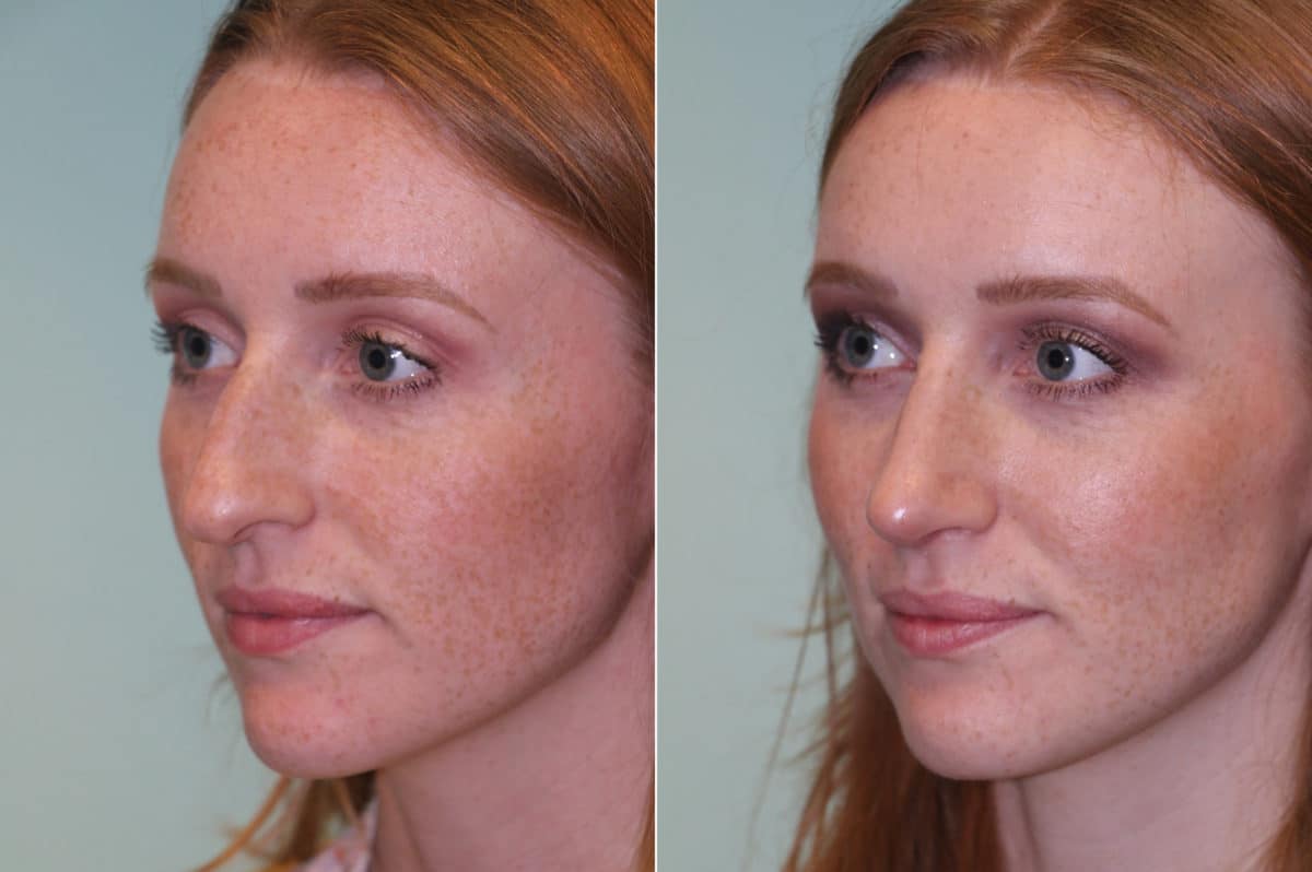 Before and after Rhinoplasty by Dr. Shervin Naderi, Patient 19638