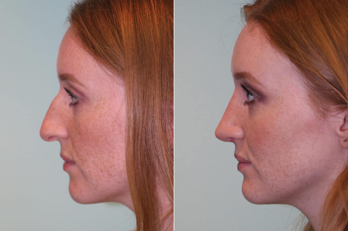 Before and after Rhinoplasty by Dr. Shervin Naderi, Patient 19638