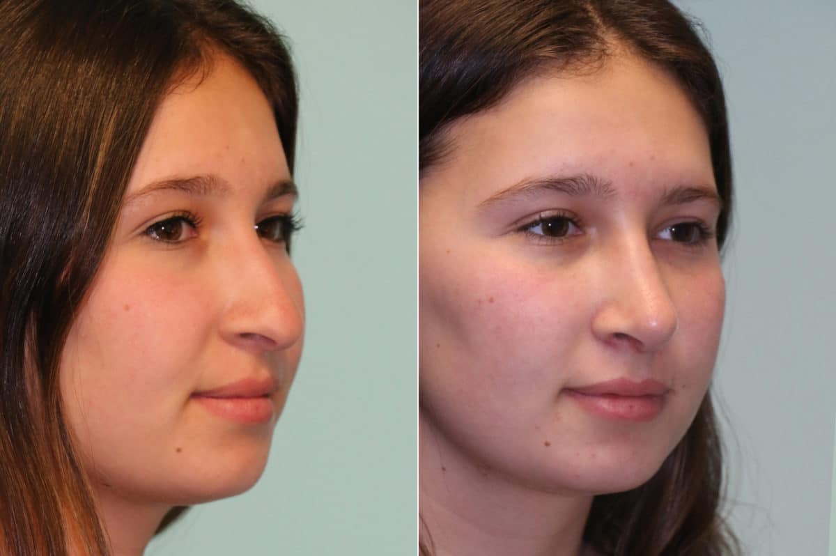 Before and after Rhinoplasty by Dr. Shervin Naderi, Patient 19667