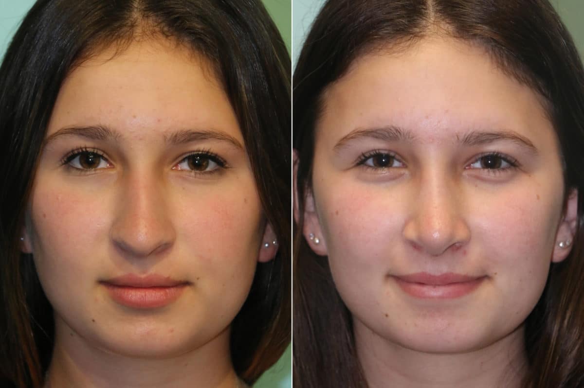 Before and after Rhinoplasty by Dr. Shervin Naderi, Patient 19667