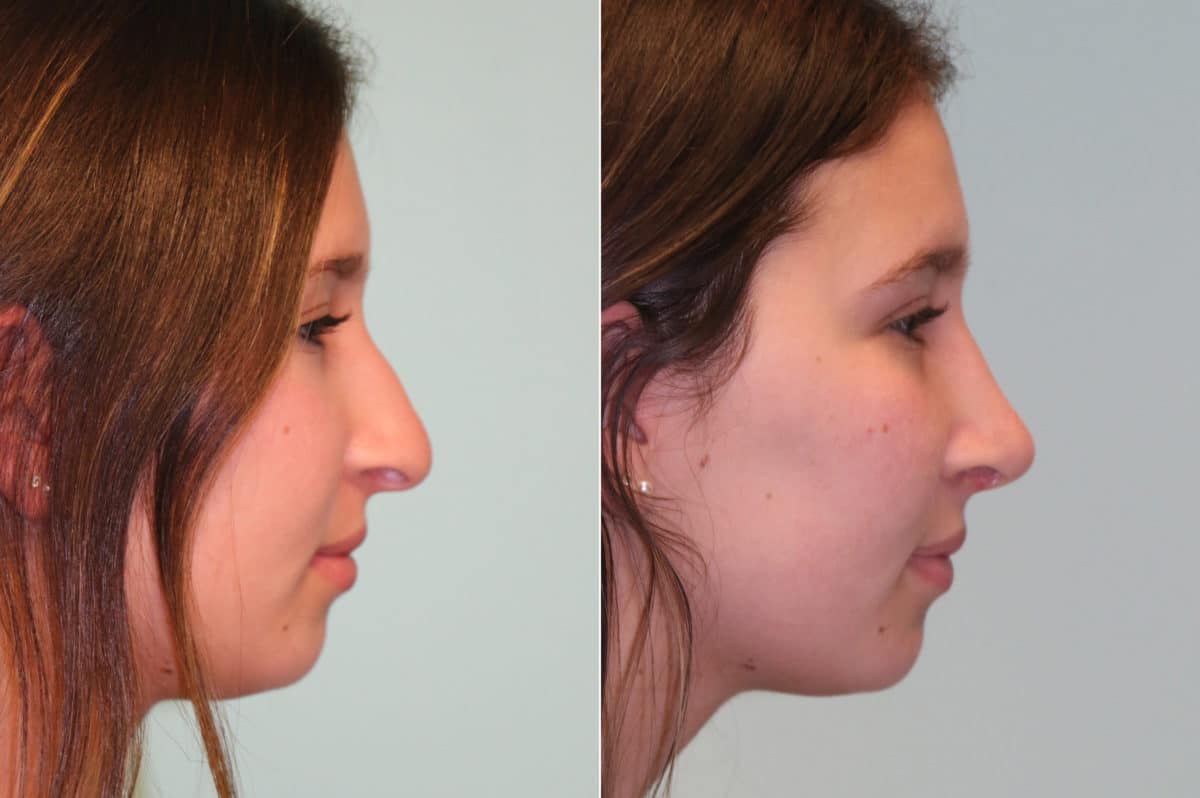 Before and after Rhinoplasty by Dr. Shervin Naderi, Patient 19667