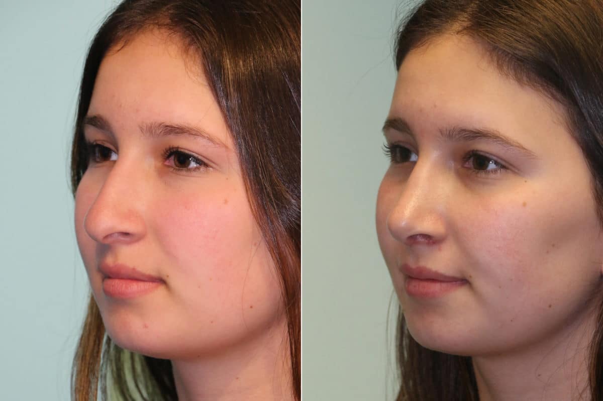 Before and after Rhinoplasty by Dr. Shervin Naderi, Patient 19667