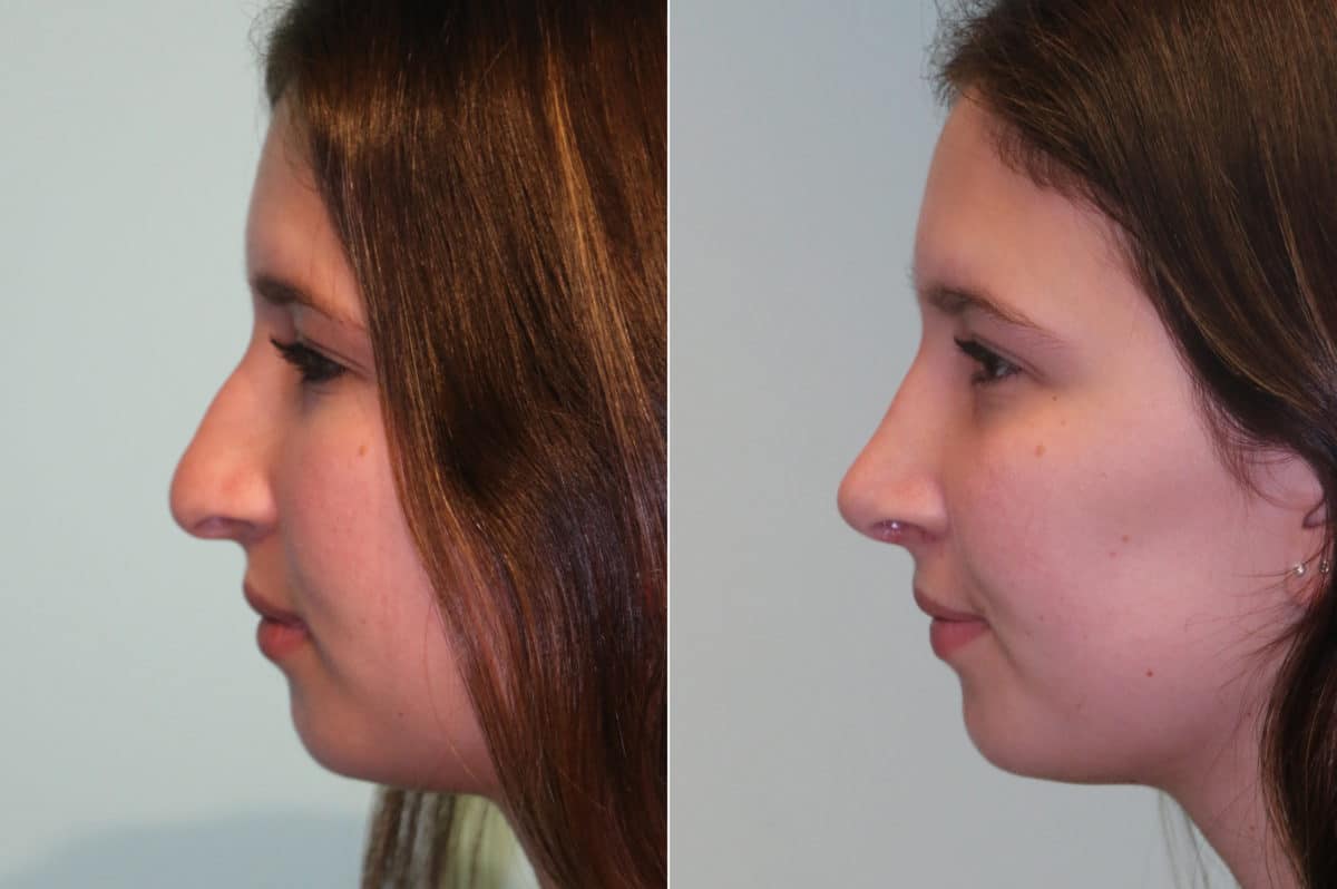 Before and after Rhinoplasty by Dr. Shervin Naderi, Patient 19667