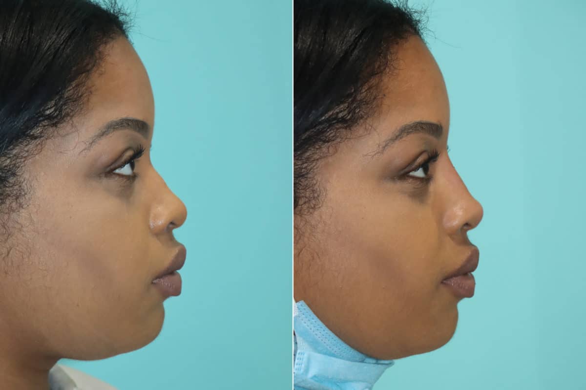 Before and after Non-Surgical Rhinoplasty by Dr. Shervin Naderi, Patient 19683