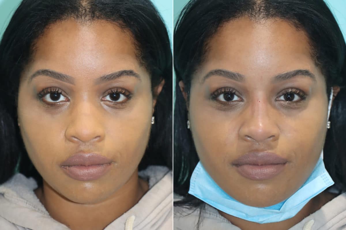 Before and after Non-Surgical Rhinoplasty by Dr. Shervin Naderi, Patient 19683