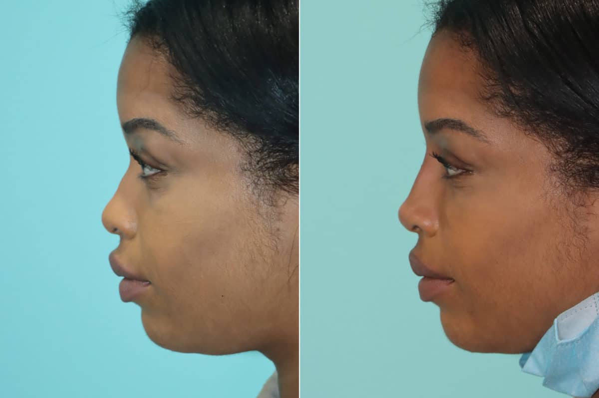 Before and after Non-Surgical Rhinoplasty by Dr. Shervin Naderi, Patient 19683