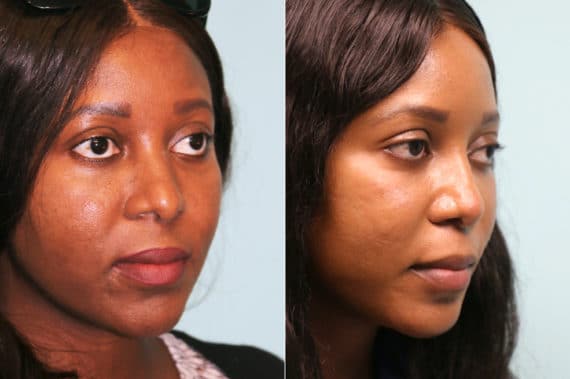 Before and after Rhinoplasty by Dr. Shervin Naderi, Patient 19710