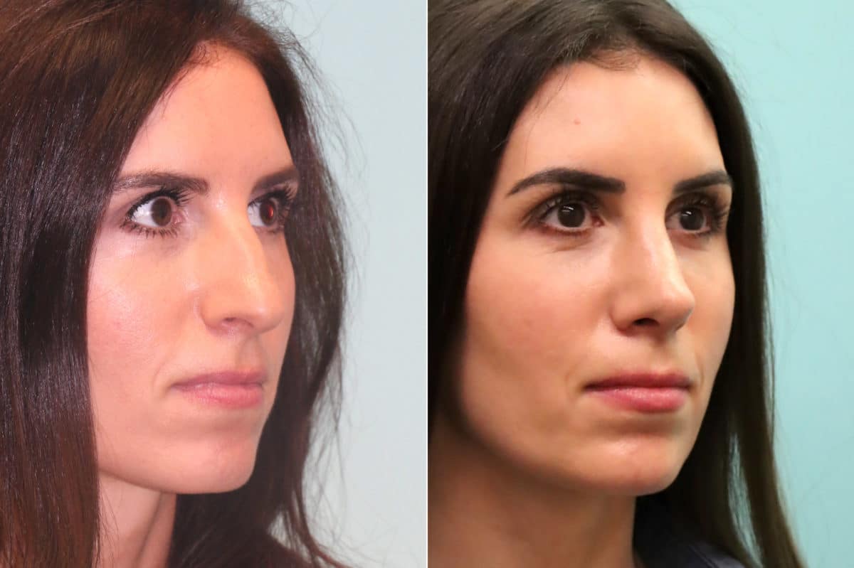 Before and after Rhinoplasty by Dr. Shervin Naderi, Patient 19770