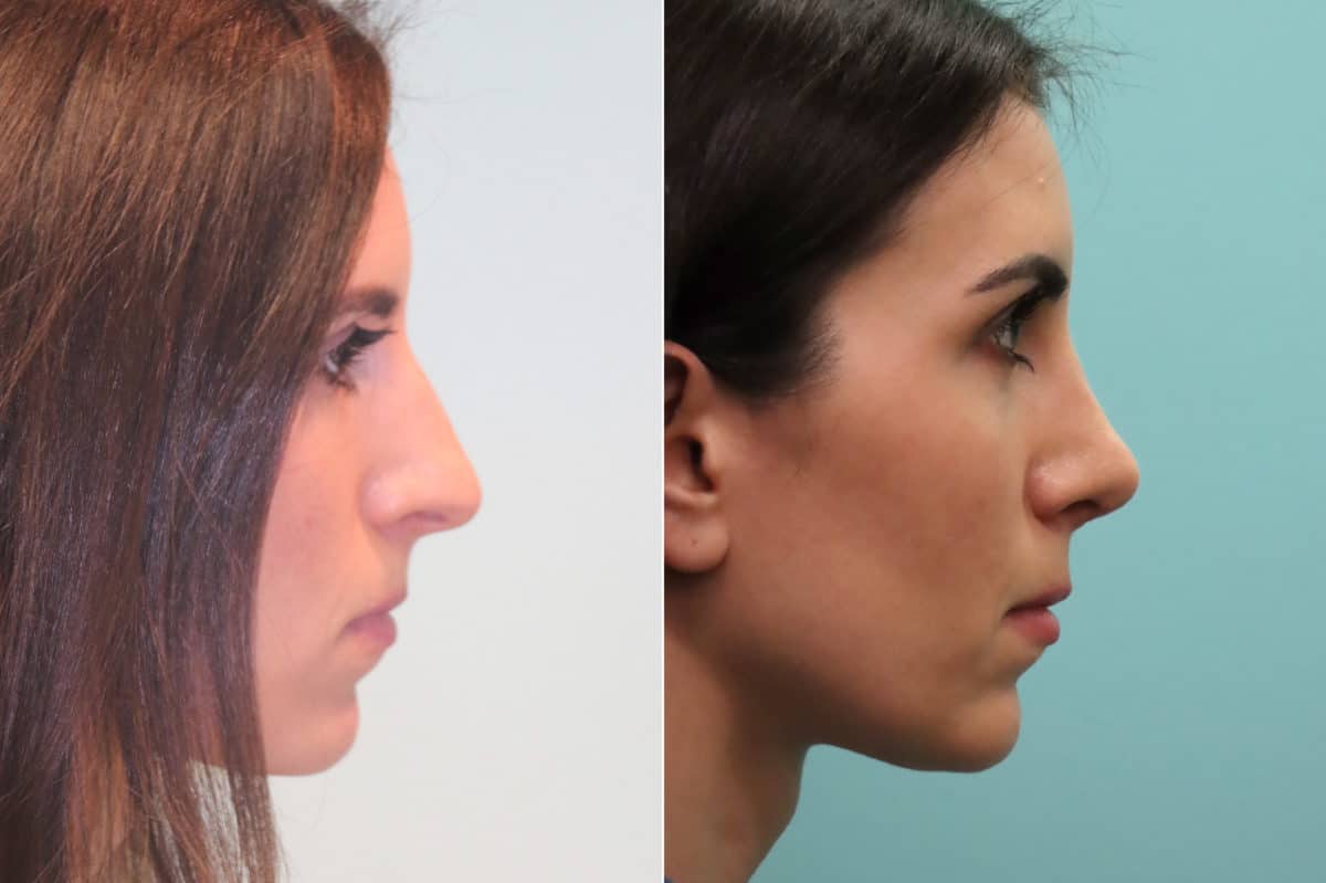 Before and after Rhinoplasty by Dr. Shervin Naderi, Patient 19770