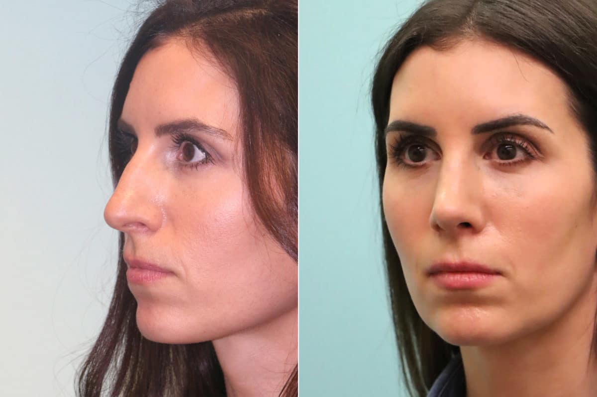 Before and after Rhinoplasty by Dr. Shervin Naderi, Patient 19770