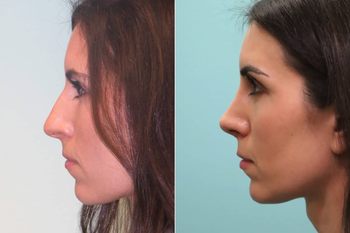 Before and after Rhinoplasty by Dr. Shervin Naderi, Patient 19770