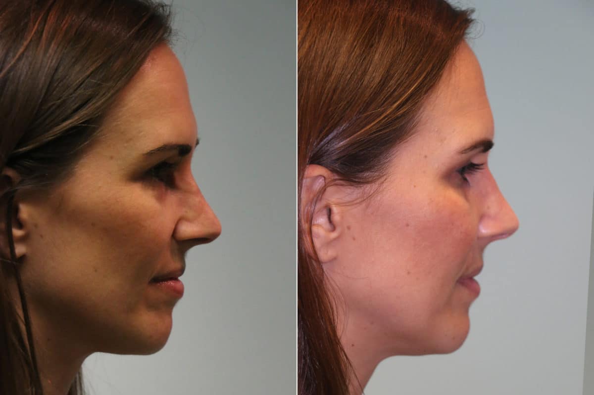 Before and after Revision Rhinoplasty by Dr. Shervin Naderi, Patient 19790