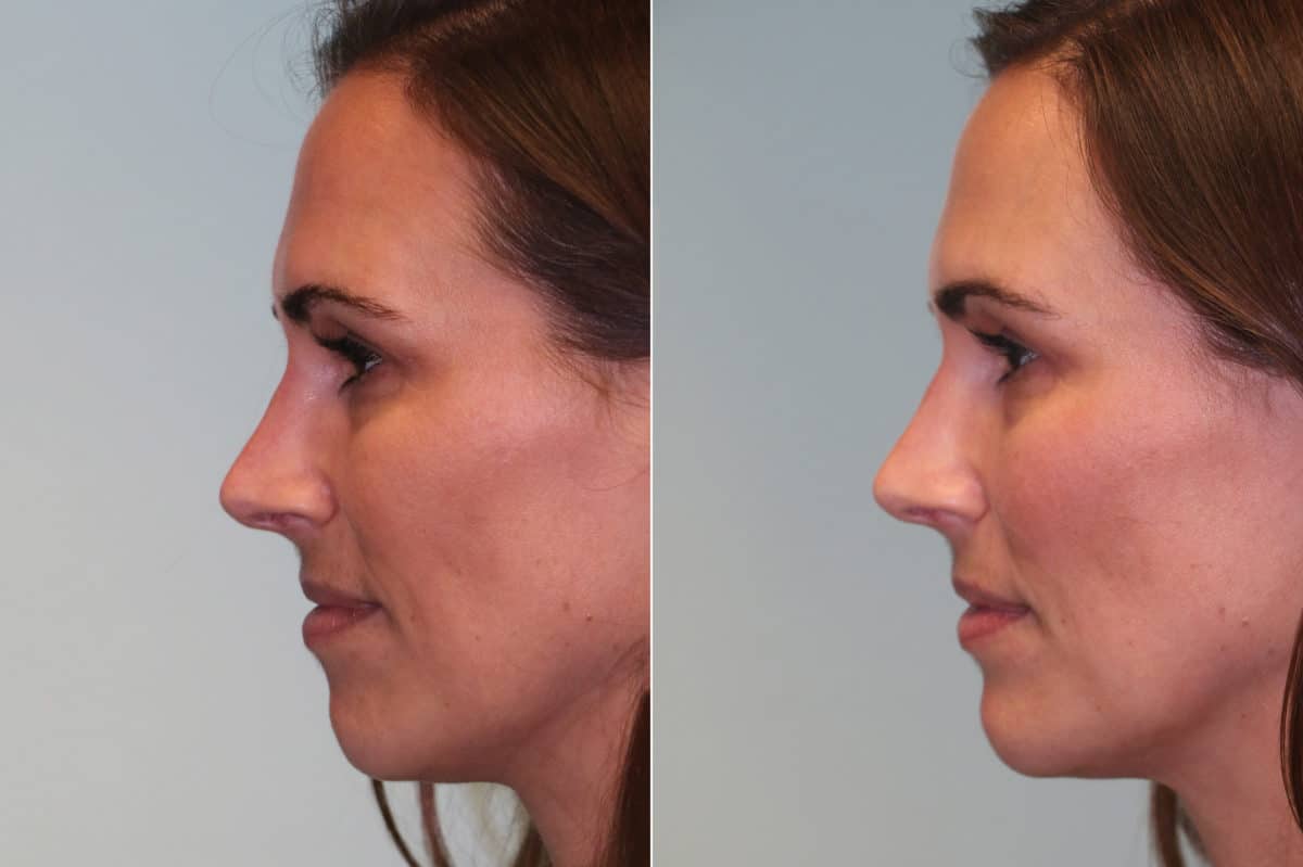 Before and after Revision Rhinoplasty by Dr. Shervin Naderi, Patient 19790