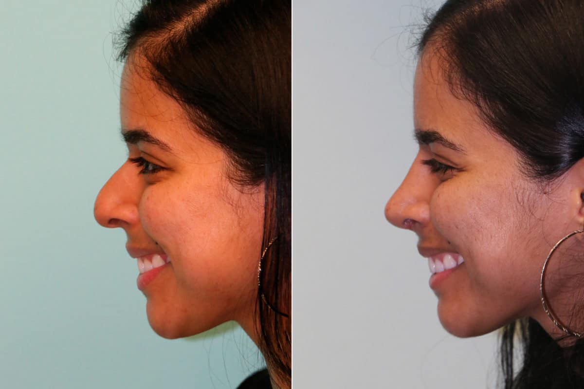 Before and after Rhinoplasty by Dr. Shervin Naderi, Patient 19826