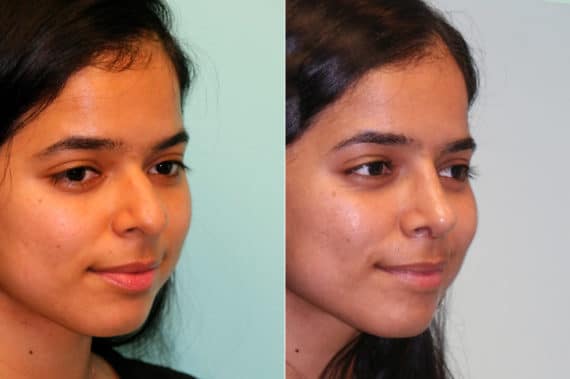 Before and after Rhinoplasty by Dr. Shervin Naderi, Patient 19826