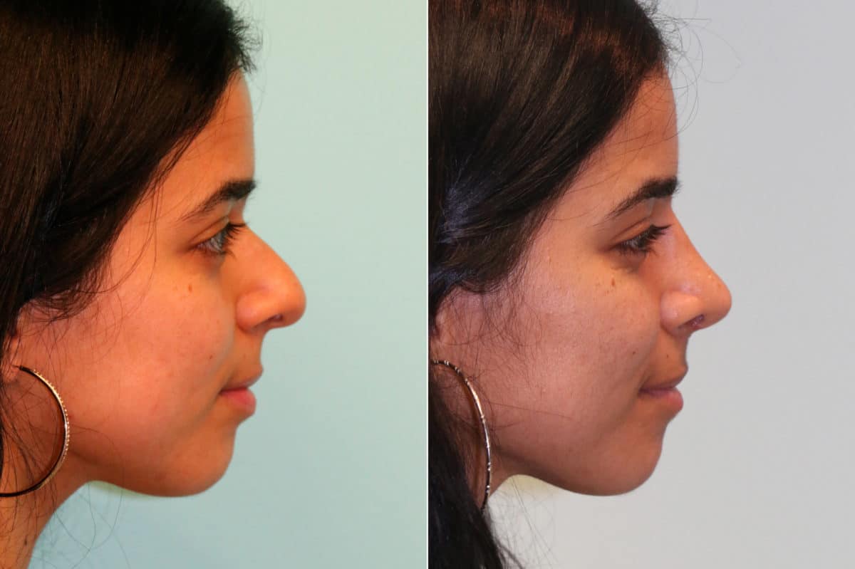 Before and after Rhinoplasty by Dr. Shervin Naderi, Patient 19826