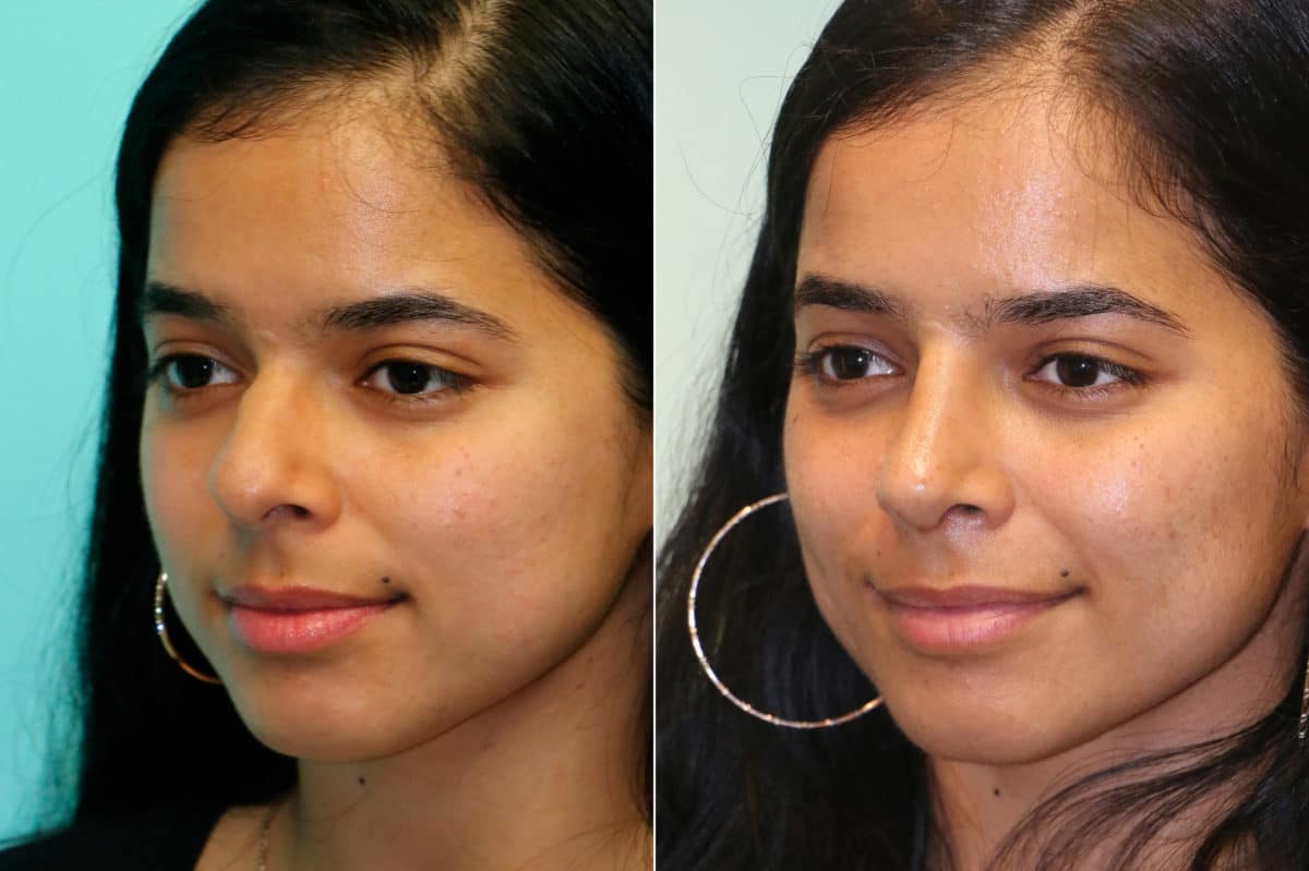 Before and after Rhinoplasty by Dr. Shervin Naderi, Patient 19826