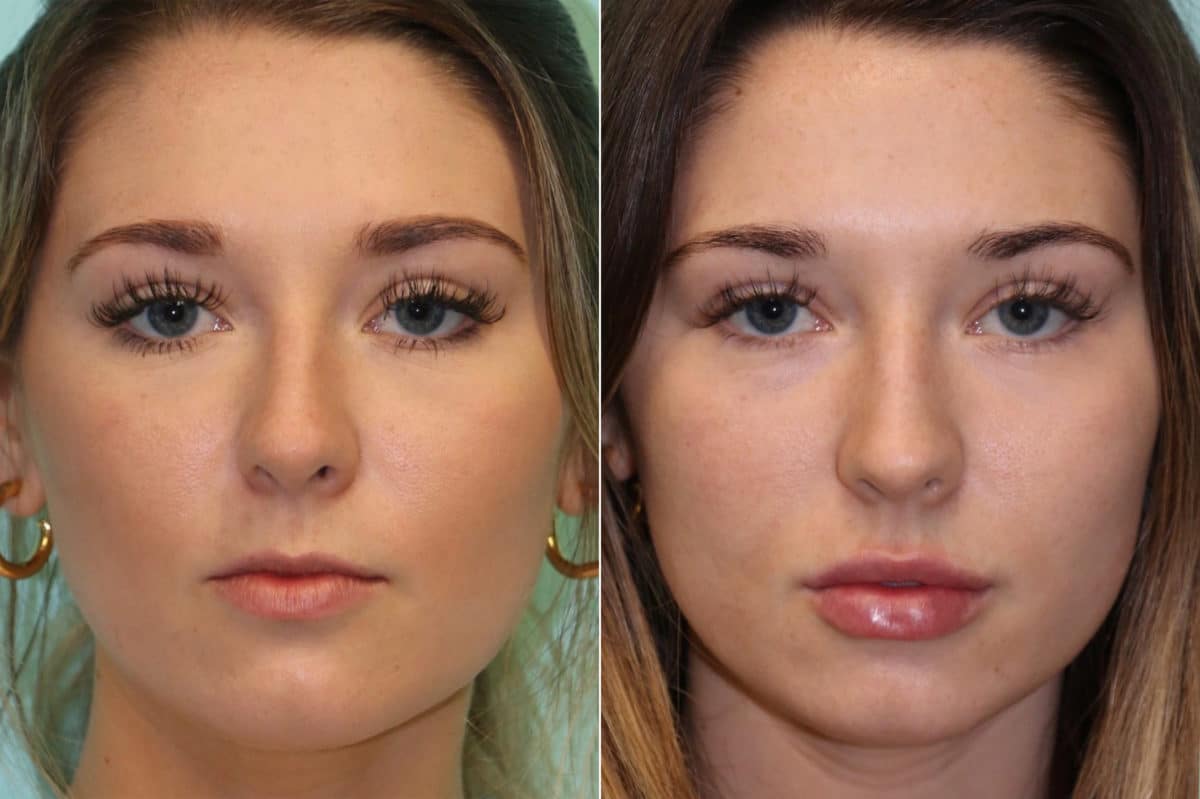 Before and after Lip Augmentation by Dr. Shervin Naderi, Patient 19879