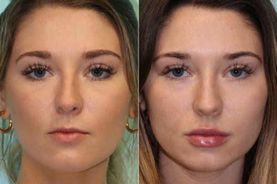 Before and after Lip Augmentation by Dr. Shervin Naderi, Patient 19879