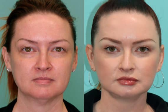 Before and after Blepharoplasty by Dr. Shervin Naderi, Patient 19942