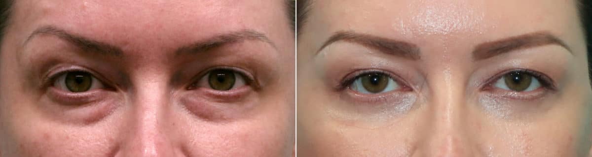 Before and after Blepharoplasty by Dr. Shervin Naderi, Patient 19942