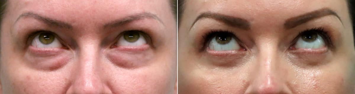 Before and after Blepharoplasty by Dr. Shervin Naderi, Patient 19942