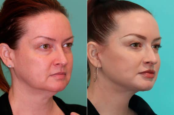 Before and after Facelift by Dr. Shervin Naderi, Patient 19943