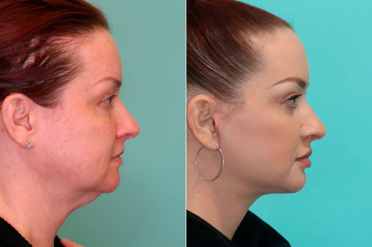 Before and after Facelift by Dr. Shervin Naderi, Patient 19943