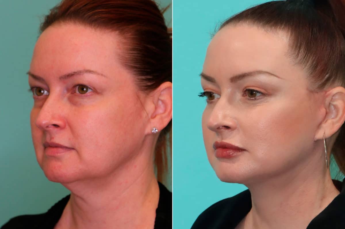 Before and after Facelift by Dr. Shervin Naderi, Patient 19943