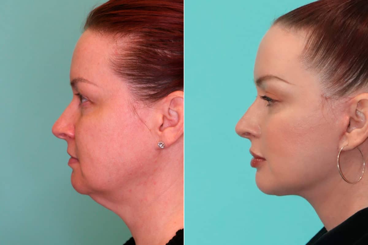 Before and after Facelift by Dr. Shervin Naderi, Patient 19943