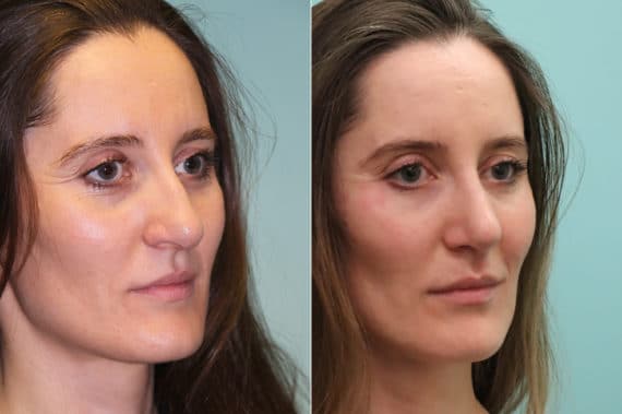 Before and after Rhinoplasty by Dr. Shervin Naderi, Patient 19975