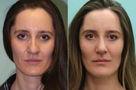 Before and after Rhinoplasty by Dr. Shervin Naderi, Patient 19975