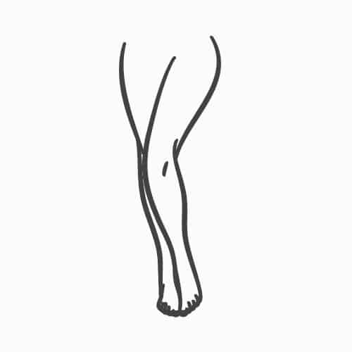 Labiaplasty Pre & Post Operative