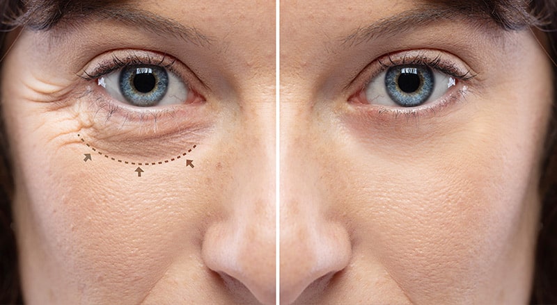 Tear troughs are depressions formed in the region between the lower eyelid and cheeks.