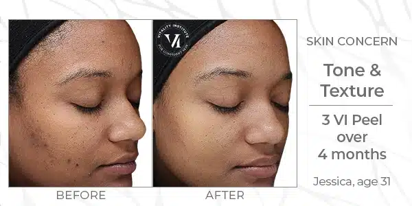 Chemical Peel Before & After