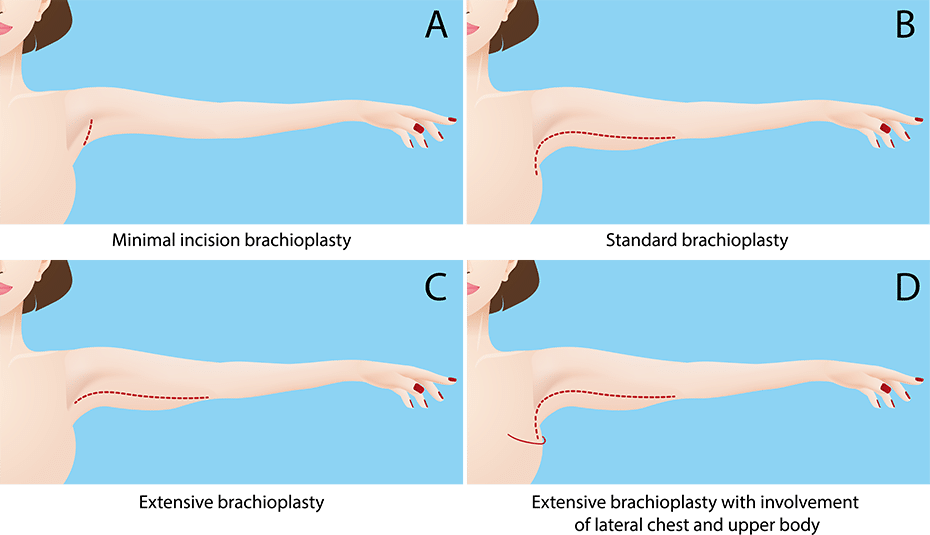 Before and After Images of Brachioplasty Procedures - Atrium Health Wake  Forest Baptist