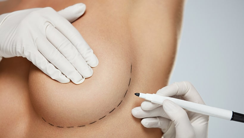 Breast Augmentation Scars: What to Expect