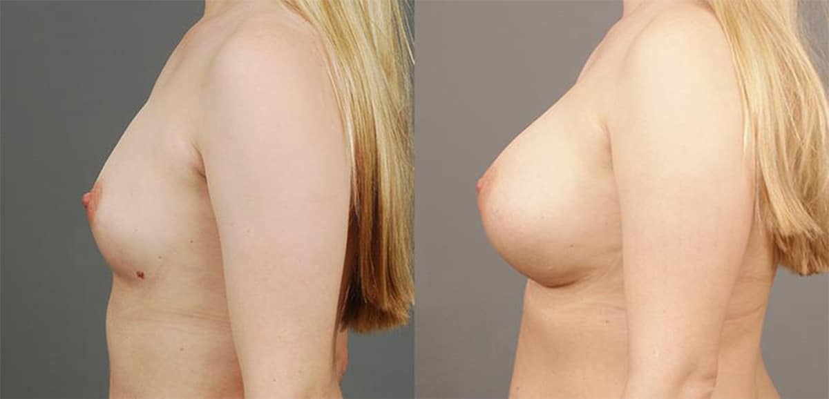 Breast Augmentation Virginia, Washington D.C. & Maryland