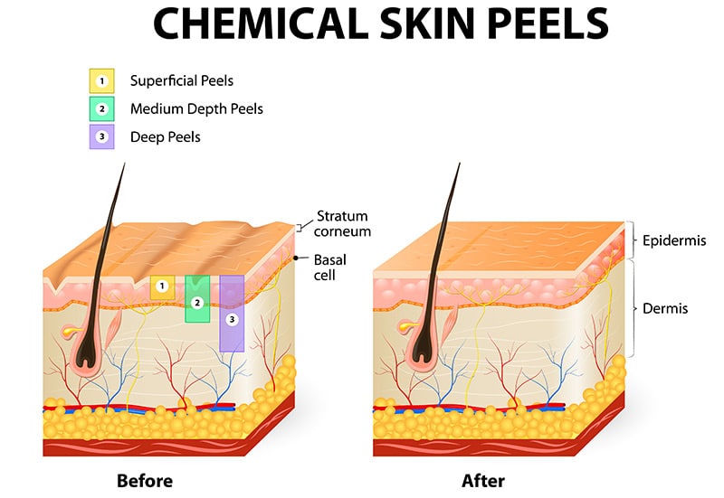 Chemical peels are classified based on the depth of skin penetration.