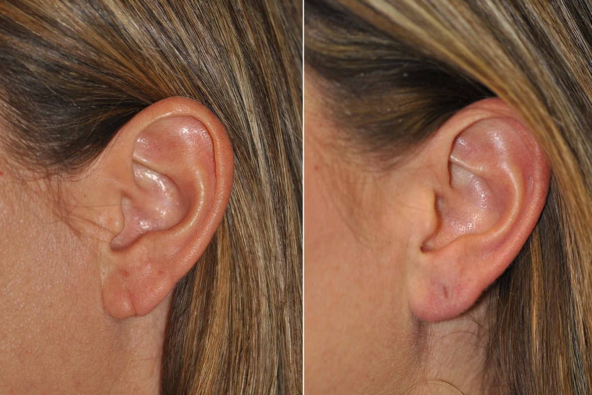 Ear Piercing After Earlobe Repair