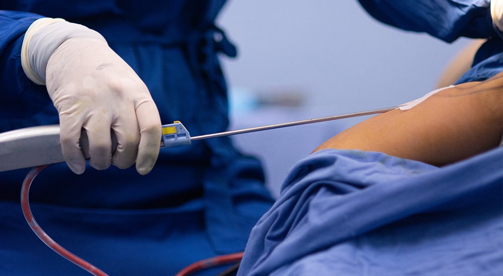 Using a thin cannula fat is extracted using a liposuction device. Fat is typically removed from the hips, inner or outer thighs, lower back, or lower abdomen.