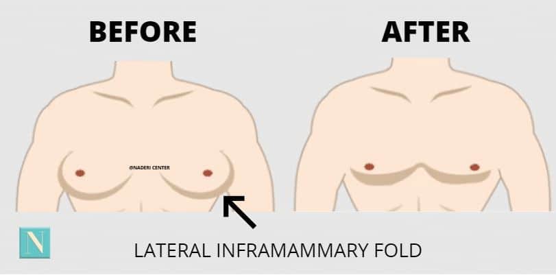 Diagram showing where our surgeon places the small incision in order to perform liposuction of the breast tissue. 
The Naderi Center | Virginia and Maryland