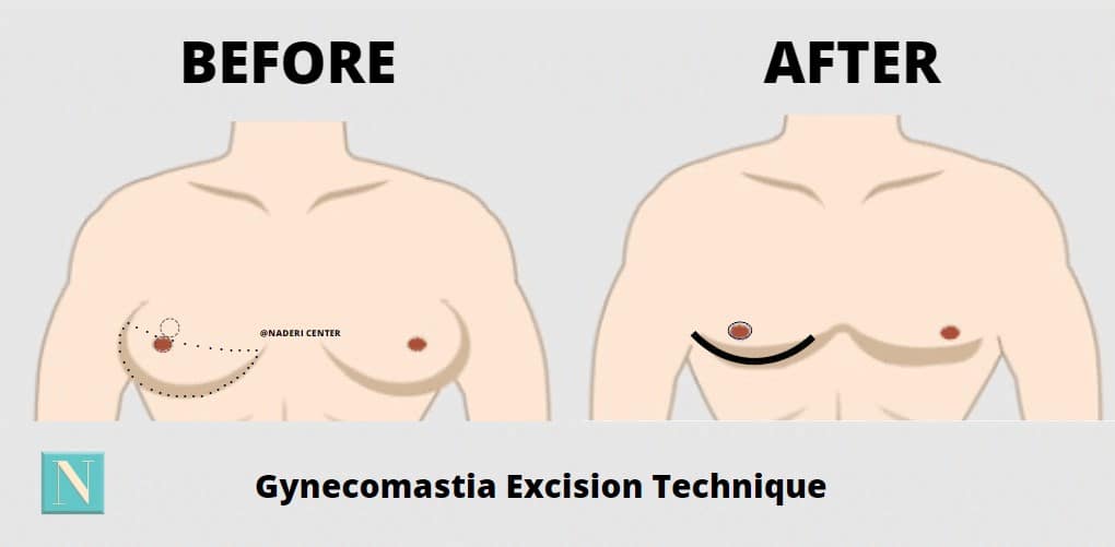 Diagram showing where your incisions would be placed when undergoing tissue excision with gynecomastia correction. 
