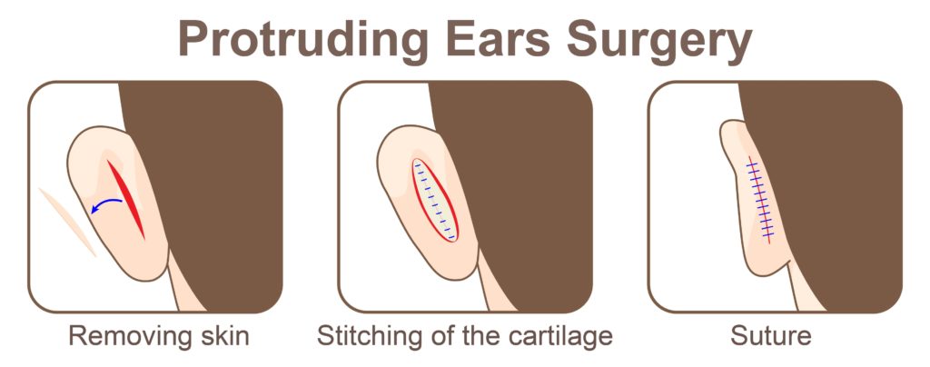 The Farrior technique involves partial thickness incisions along the rim of the conchal cartilage.
The Naderi Center | Virginia, Washington D.C. and Maryland.