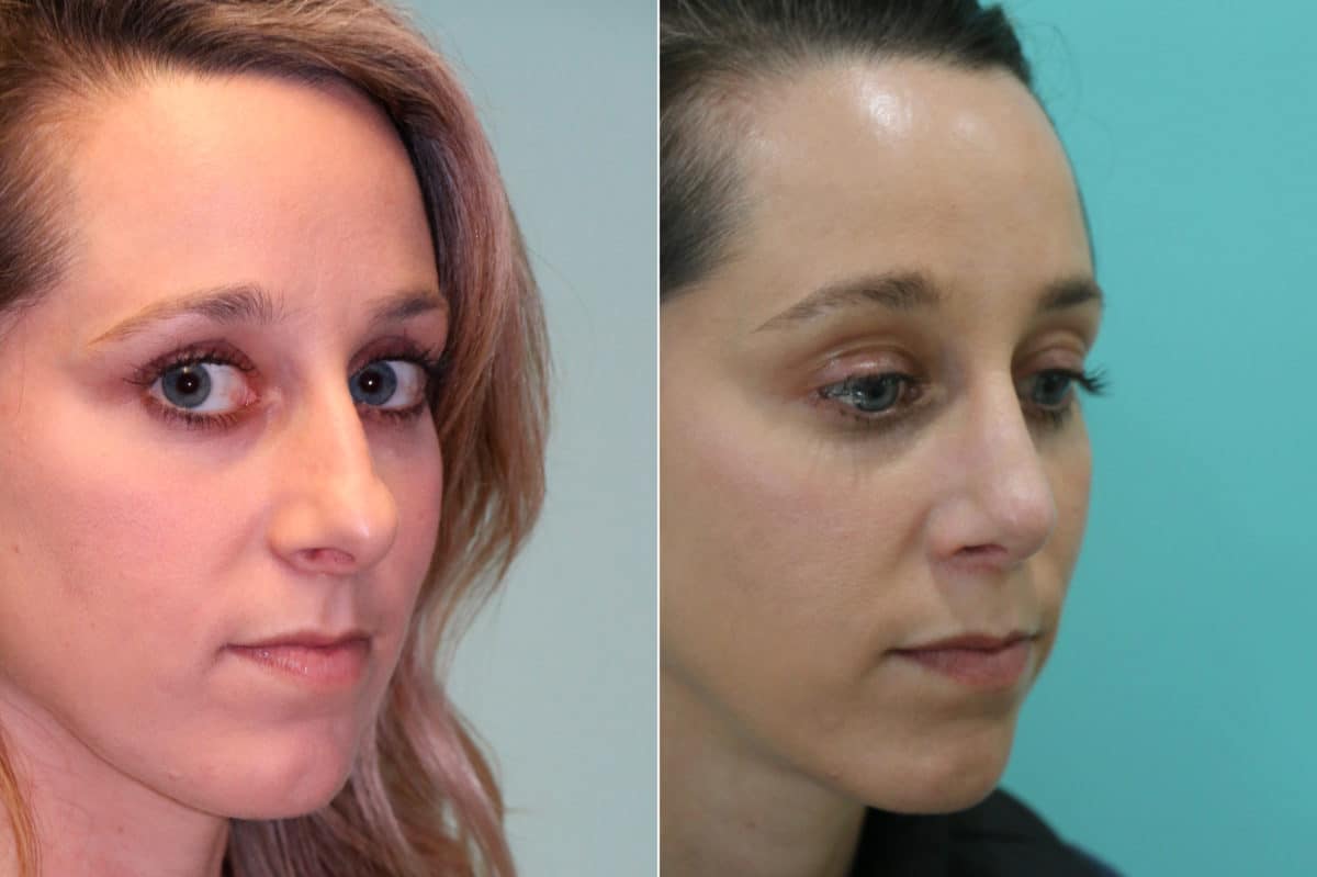 Before and after Rhinoplasty by Dr. Shervin Naderi, Patient 19032