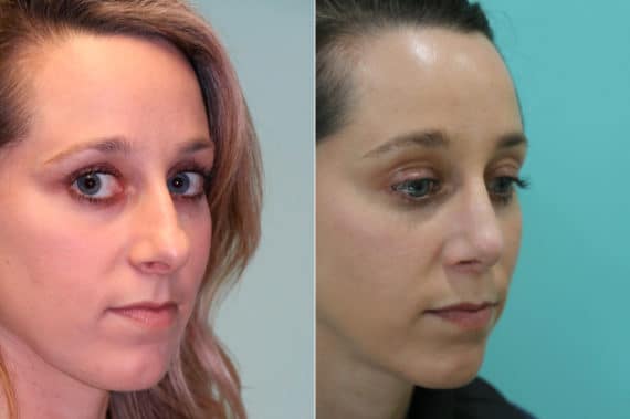 Before and after Rhinoplasty by Dr. Shervin Naderi, Patient 19032