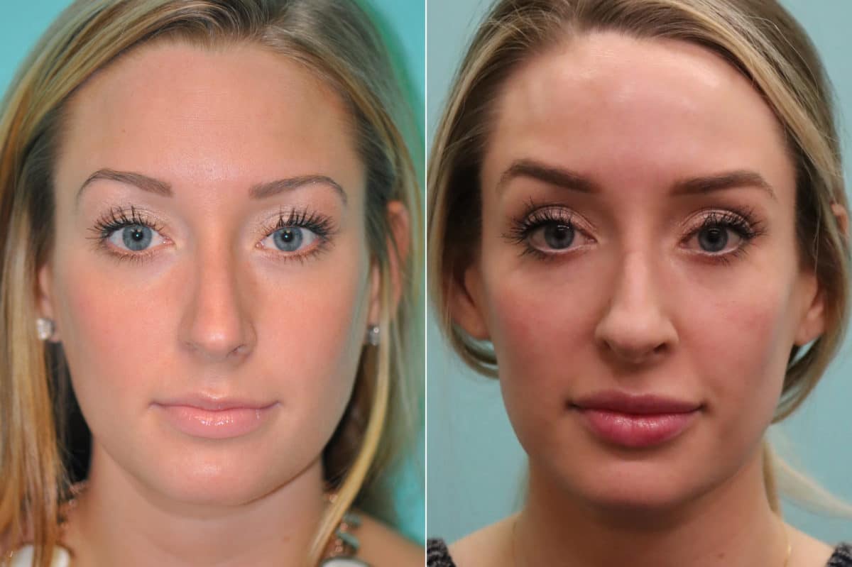 Before and after Lip Augmentation by Dr. Shervin Naderi, Patient 20136