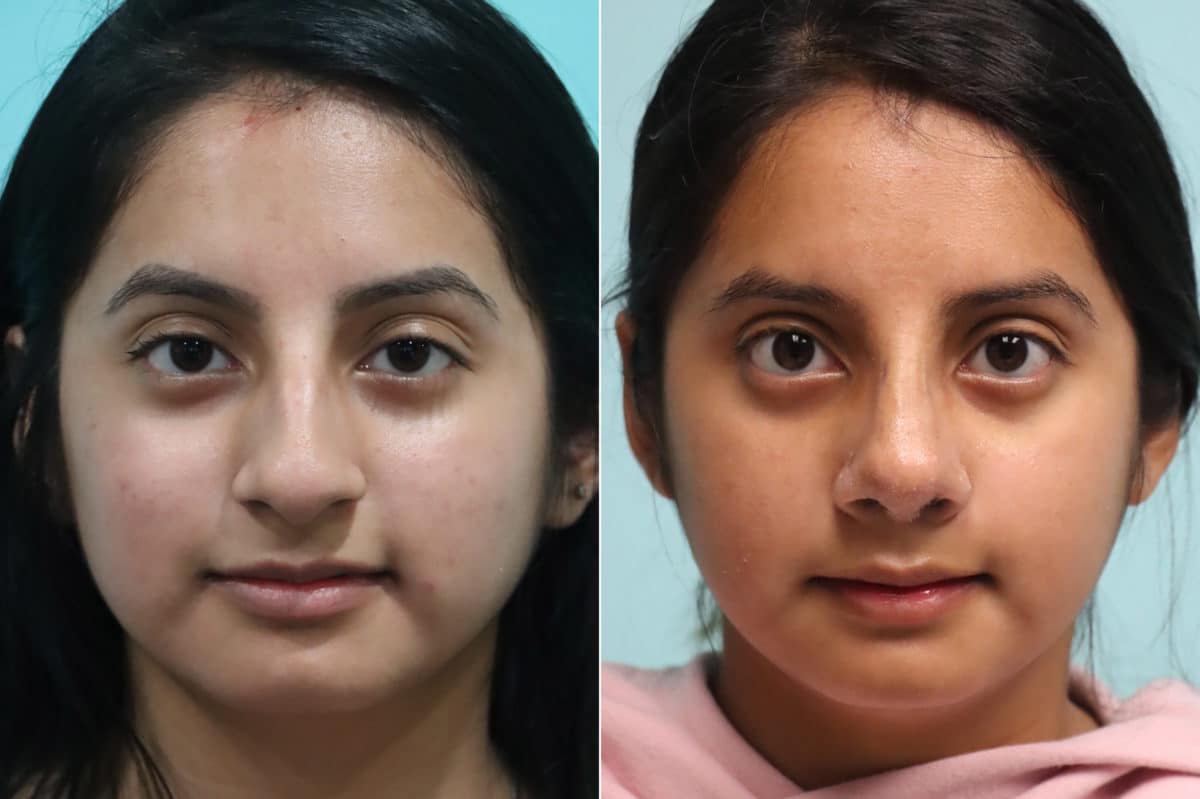 Before and after Rhinoplasty by Dr. Shervin Naderi, Patient 20174